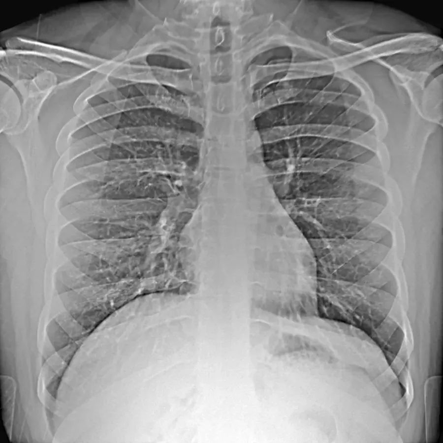 Normal imaging mode